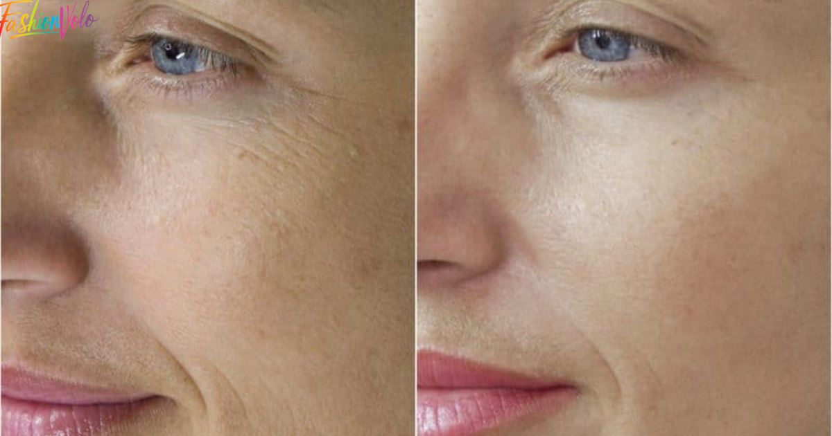 Plasma Fibroblast Before and After for Face Skin