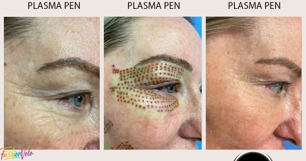 The Step-by-Step Process of a Plasma Pen Day-by-Day Healing