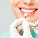 How to Choose the Right Dentist for Your Veneer Treatment in Sydney