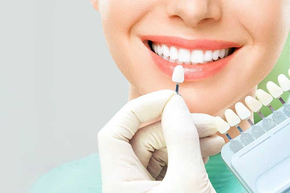 How to Choose the Right Dentist for Your Veneer Treatment in Sydney