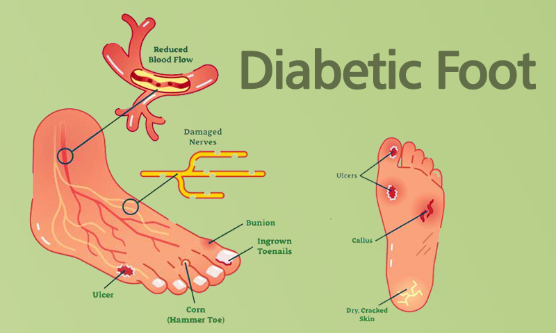 Essential Foot Care Practices Daily Foot Inspections