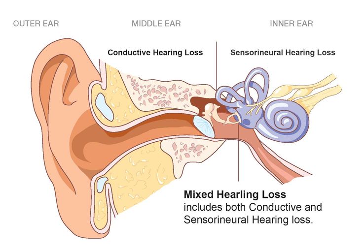 Recognizing Hearing Loss: How to Schedule a Hearing Aid Consultation